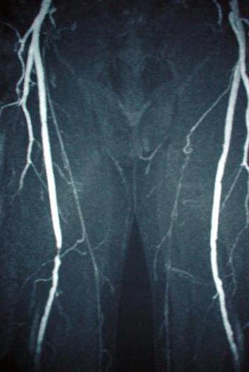 angiografia naczyń kończyn dolnych