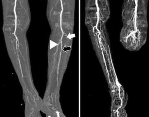 angiography of vessels of lower extremities what is it