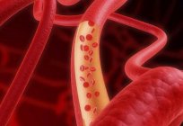 Anjiyografi ile alt ekstremite damarları: nasıl yapılır?