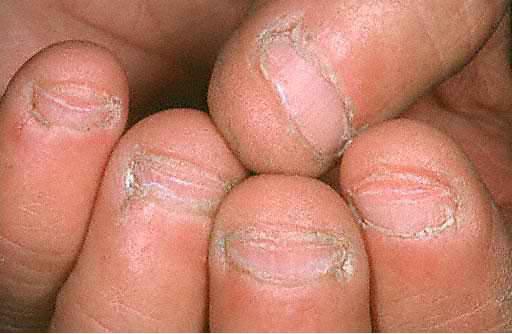 sucha skóra wokół paznokci