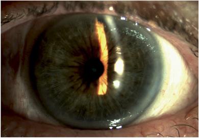 штучний кришталик ока