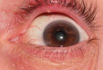 Wie zur Behandlung von Gerstenkorn am oberen Augenlid?