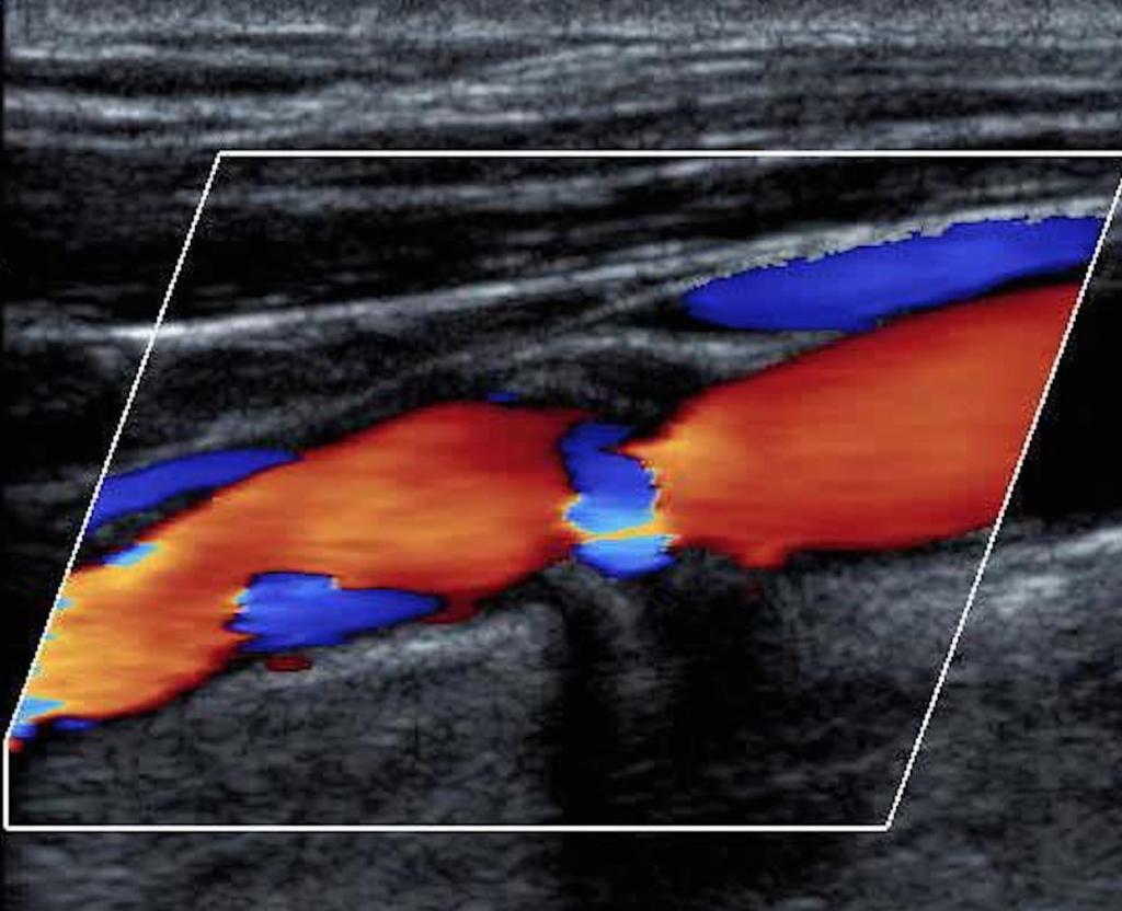 Доплерографія дуплексне сканування судин