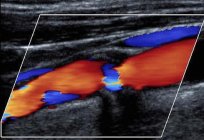 O duplex scan vascular: as indicações do procedimento, a preparação e os resultados