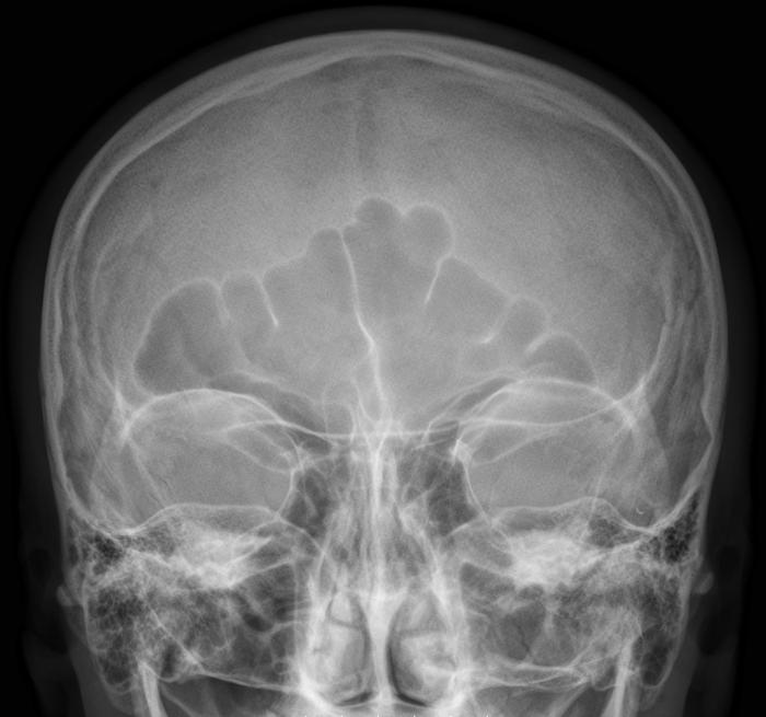 an x-ray of the sinuses
