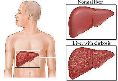 どのように治療肝臓の民間療法