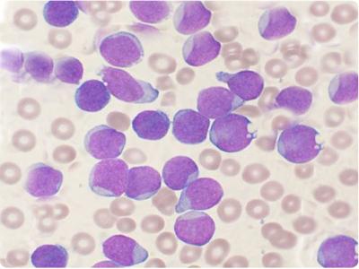 як підвищити лейкоцити в крові після хіміотерапії