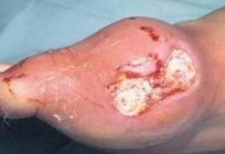 The treatment of purulent wounds on the feet. Drugs. Folk remedies