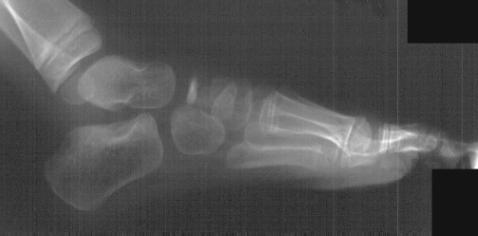 Fuß Röntgen