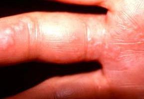 Herpes an den Händen