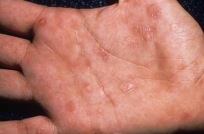 herpes on the hands pictures