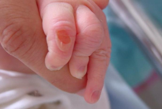 herpes on the hands of a child
