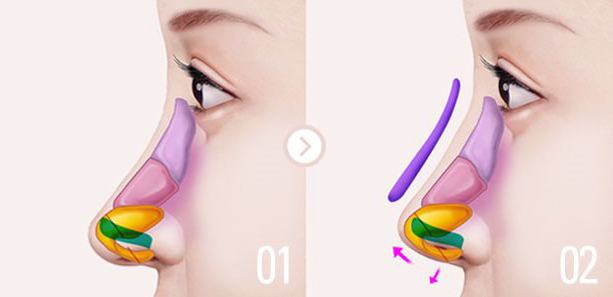 la cirugía para la corrección de la deformación de la punta de la nariz