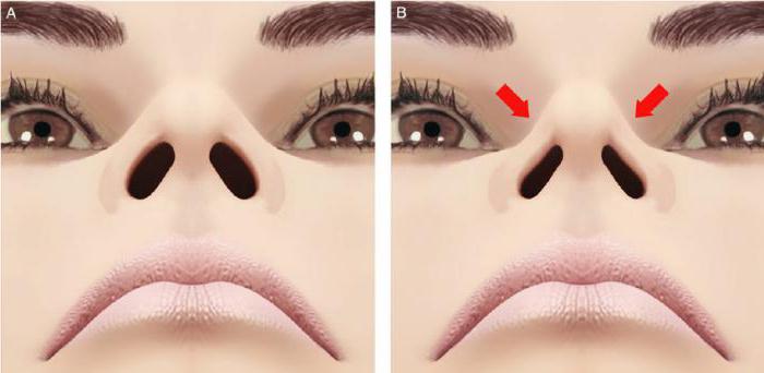 la rinoplastia corrección de la punta de la nariz
