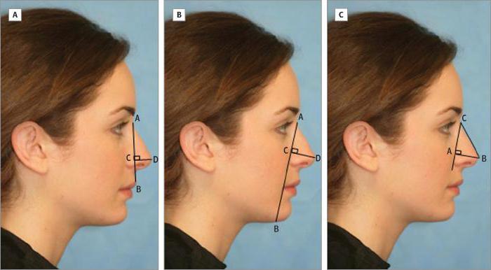 Korrektur der Nasenspitze ohne Operation