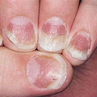 ониходистрофия нігтів лікування