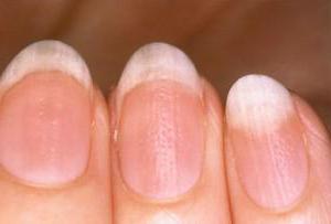 treatment of onychodystrophy the fingernails