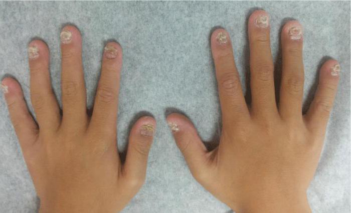 ониходистрофия нігтів у дітей лікування