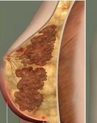 zapalenie sutka podczas karmienia piersią
