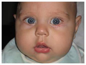 Monate altes Baby eitert das Auge