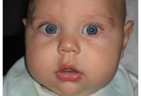 Abominable de los ojos del niño: qué hacer, si no existe la posibilidad de visitar a un oftalmólogo