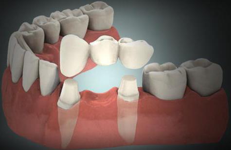 diş implantları