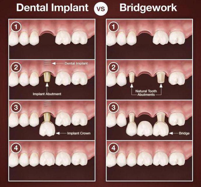 мост або імпланты на жавальны зуб водгукі