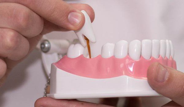 أنواع من الأسنان والجسور