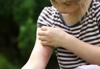 Abnehmen der Juckreiz von den Bissen der Mücken bei Erwachsenen und Kindern? Gute Beratung