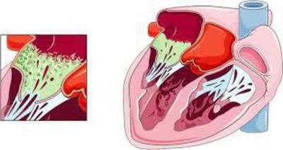 Infectious endocarditis