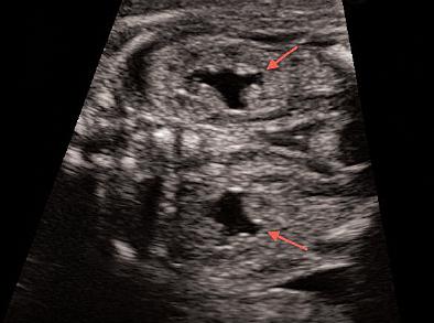 bilateral pyelectasis in a fetus