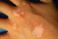 White spots on hands - what is it? Hands were white spots: causes