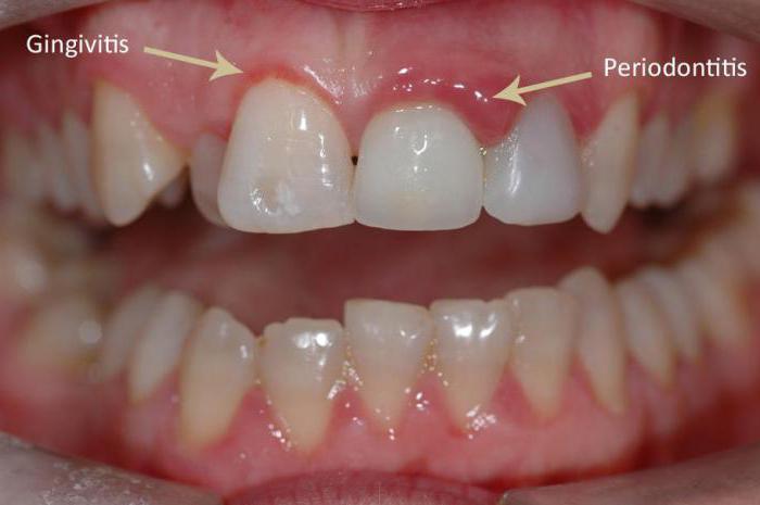 gum disease photo