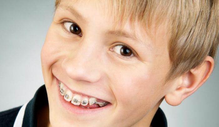 Kinder-Zahnspange