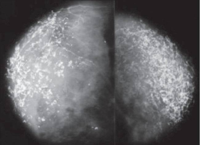 Scattered microcalcifications in the breast