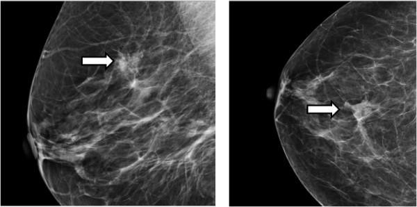 Cluster of microcalcifications in the breast