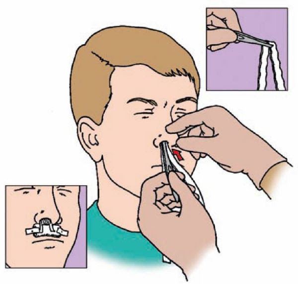Tamponade der Nase Technik