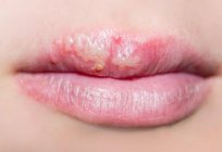 小胞に唇:原因や治療