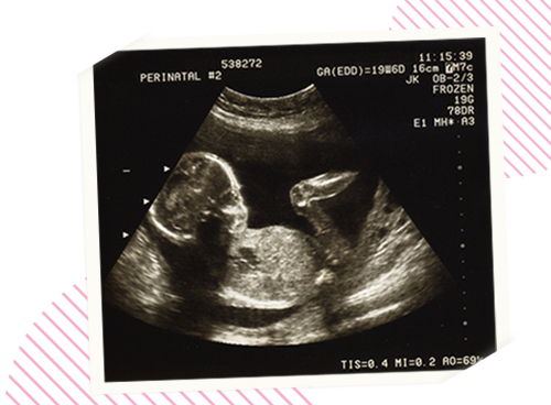 a Fetus at 20 weeks of pregnancy