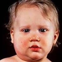 die Symptome von Mumps bei Kindern