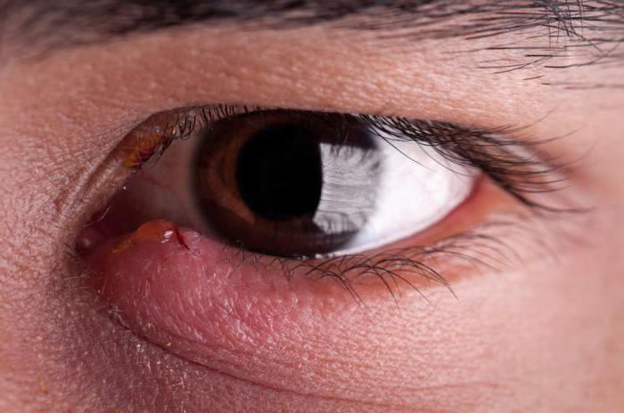 das innere Gerstenkorn am unteren Augenlid Behandlung der Ursache