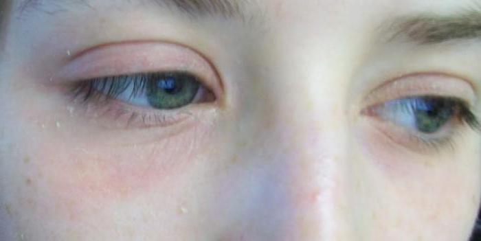 das innere Gerstenkorn am unteren Augenlid, auch unter den Augenlidern
