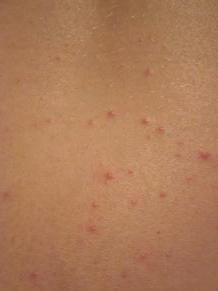 why many people have back acne