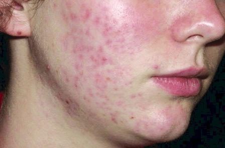 why many people have acne