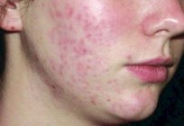 Por que muitas pessoas, a acne e outros não?