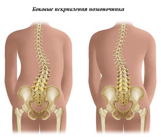 la curvatura de la columna vertebral tratamiento