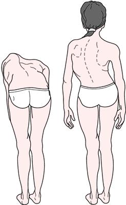 lateral curvature of the spine is