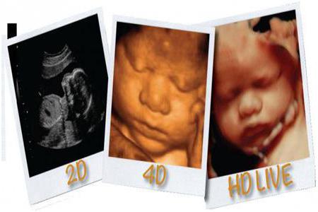 4D-Ultraschall 20 Wochen