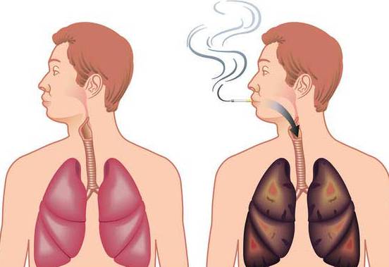 原因の肺気腫