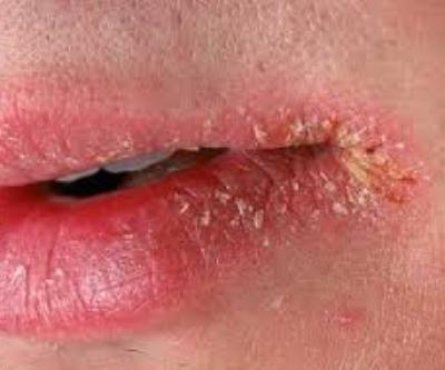 cracks in corners of lips treating